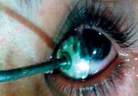LOW OR HIGH FRACTIONATION DOSE B-RADIOTHERAPY FOR PTERYGIUM? A RANDOMIZED CLINICAL TRIAL: IN REGARD TO VIANI GA ET AL